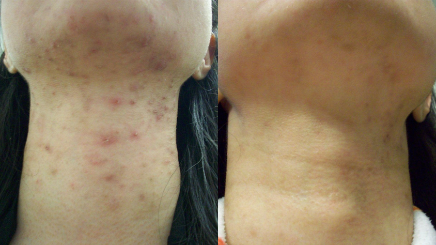 Before and after photo shared by a Lingon user