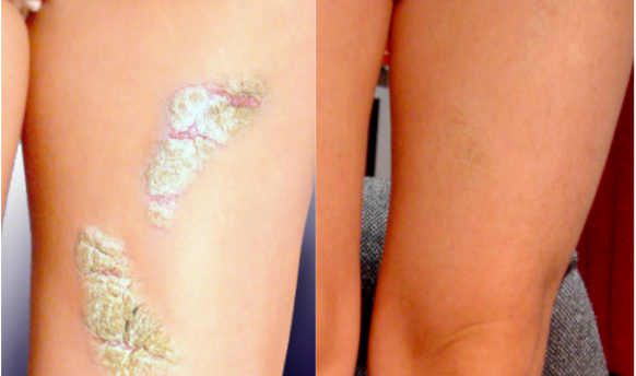 Before and after photo shared by a Lingon user