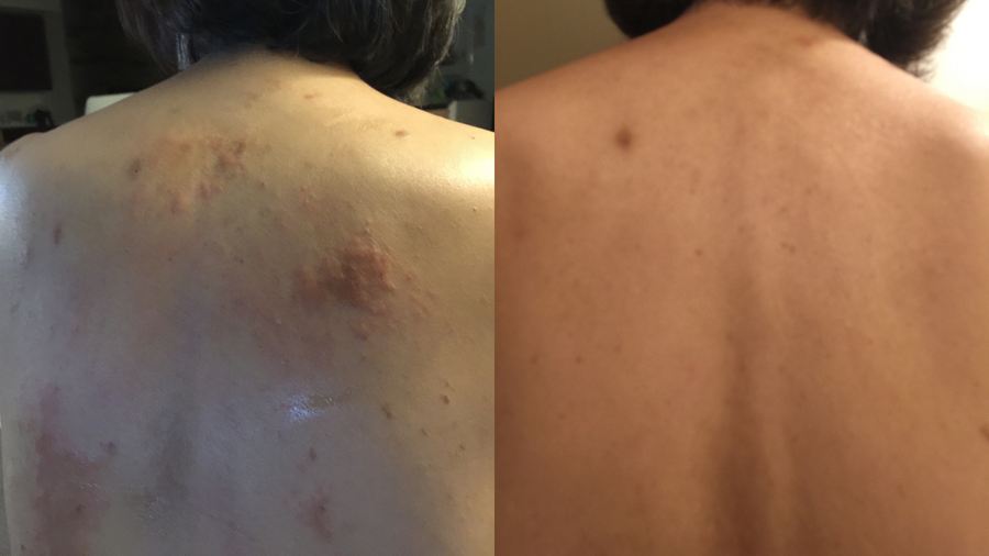 Before and after photo shared by a Lingon user