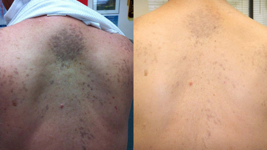 Before and after photo shared by a Lingon user
