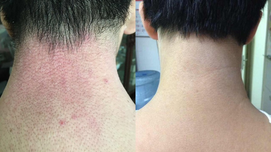 Before and after photo shared by a Lingon user