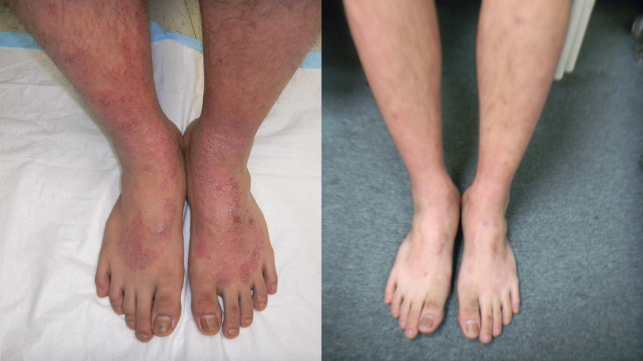 Before and after photo shared by a Lingon user