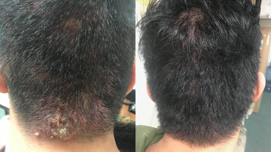 Before and after photo shared by a Lingon user