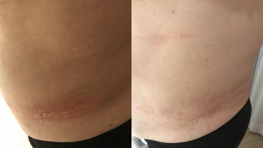 Before and after photo shared by a Lingon user